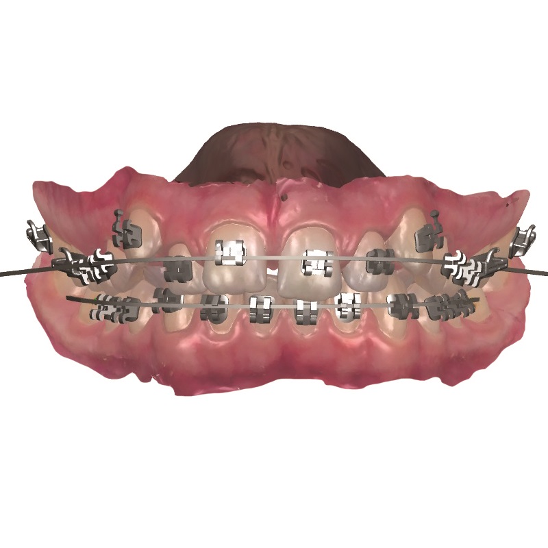 Brackets Damon Clear