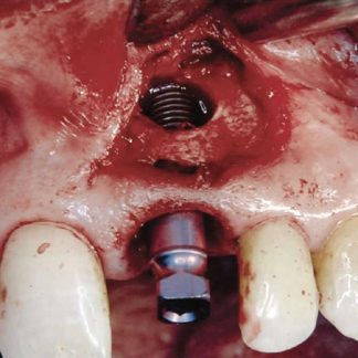Dental Implant Removal