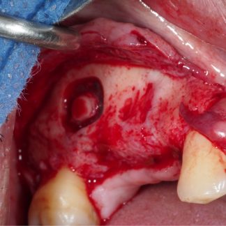 Maxillary Sinus Lift x Transcrestal