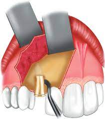 Root Fragments Extraction
