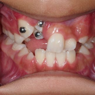 Exposición de Dientes Retenidos