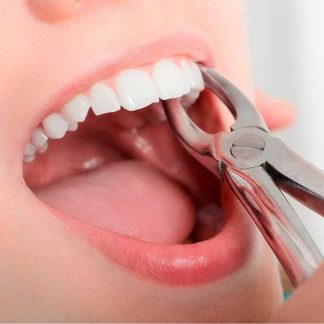 Extracción Dental Simple