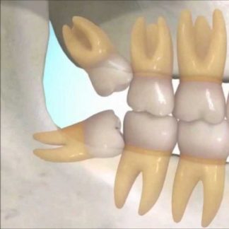 Extracción del Tercer Molar