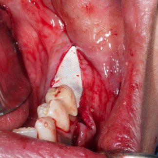 Regeneración Osea xCuadrante