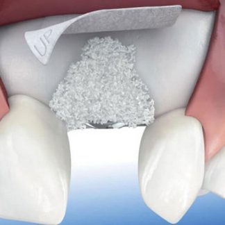 Regeneración Osea xDiente