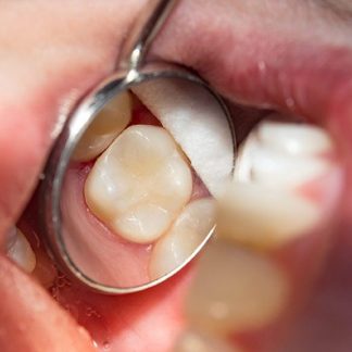 Resinas Dentales en Bordes Incisales