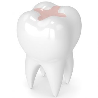 Sellado de Fosetas y Fisuras
