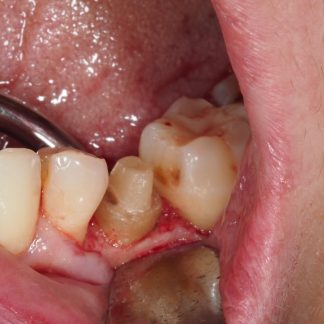 Alargamiento de Corona