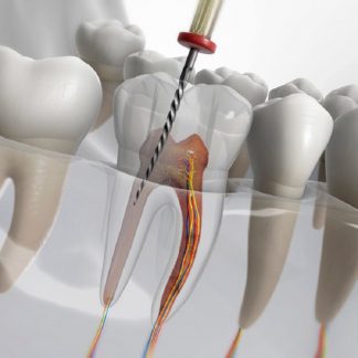 Retratamiento de Endodoncia