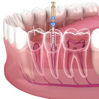 Endodoncia de Premolar