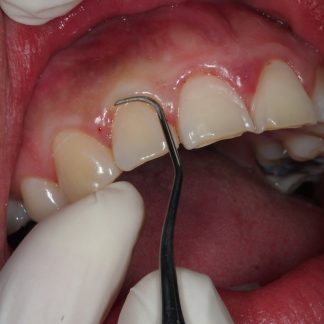 Raspado y Alisado Radicular