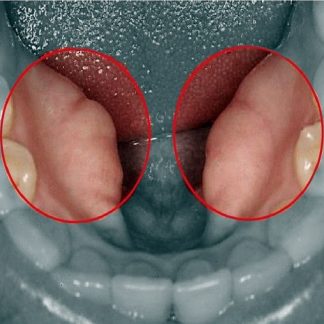 Retiro de Torus Lingual