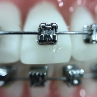 Recolocación de Bracket