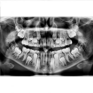 Panoramic X Ray (Orthopantomography)