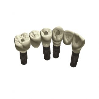 Puente de Zirconio / Implante 3U