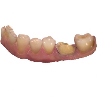 Escaneado Intraoral / Restauraciones