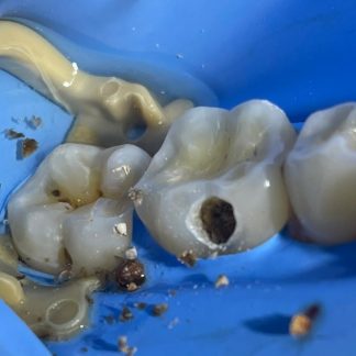 Dental Restoration Removal