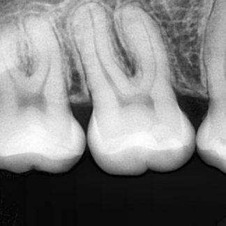 Periapical X-Ray