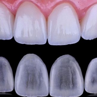 Dental Veneers